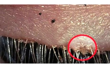 Kirpik Biti Belirtileri ve Tedavisi